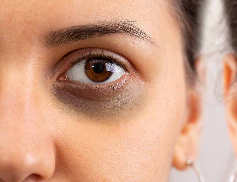What Is The Blue Ring Around Brown Eyes At Jai Papathanasopoulos Blog