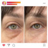 Augenringe